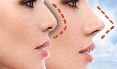 Rinoplastia, la operación estética que nos reportará estética y salud